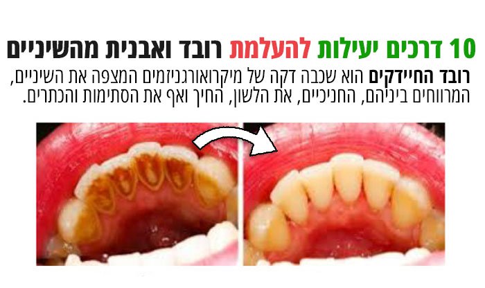 רובד-ואבנית-שיניים