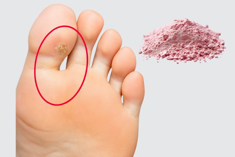 כך תסירו יבלות בתוך שבוע וחצי!